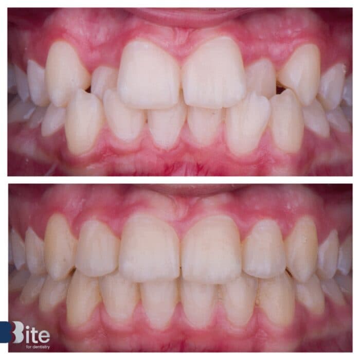 Braces — before and after, a real Bite patient