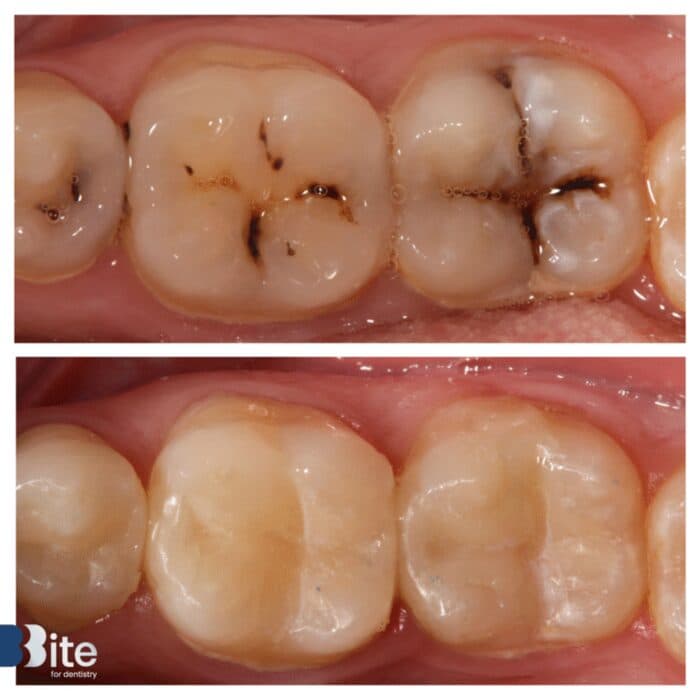 Fillings — before and after, a real Bite patient