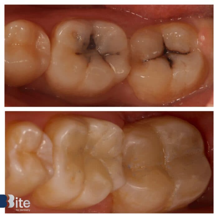 Fillings — before and after, a real Bite patient