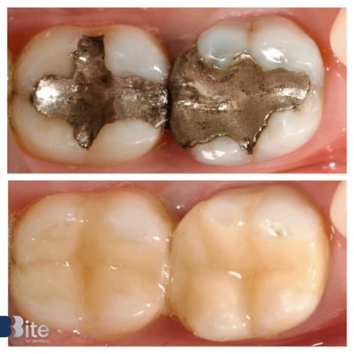 Fillings — before and after, a real Bite patient