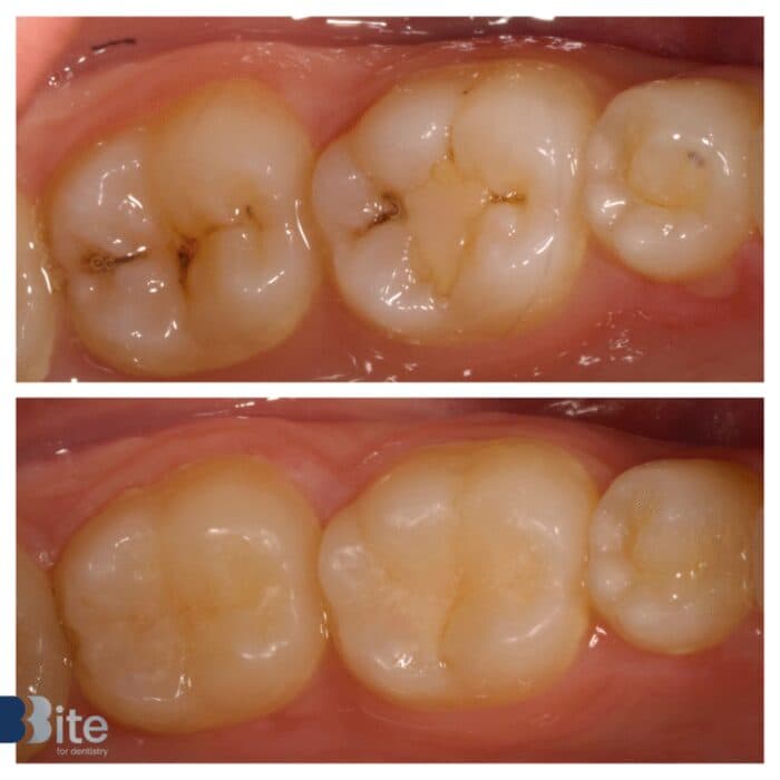 Fillings — before and after, a real Bite patient