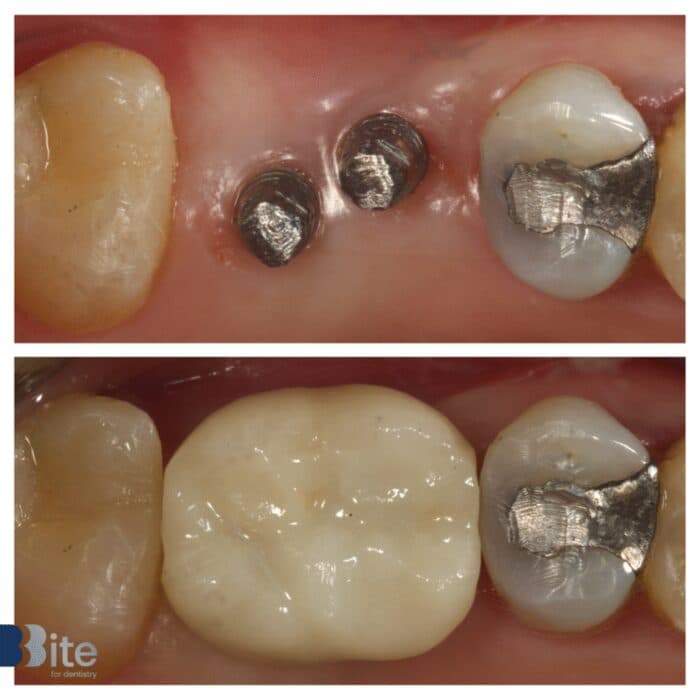 Implants — before and after, a real Bite patient