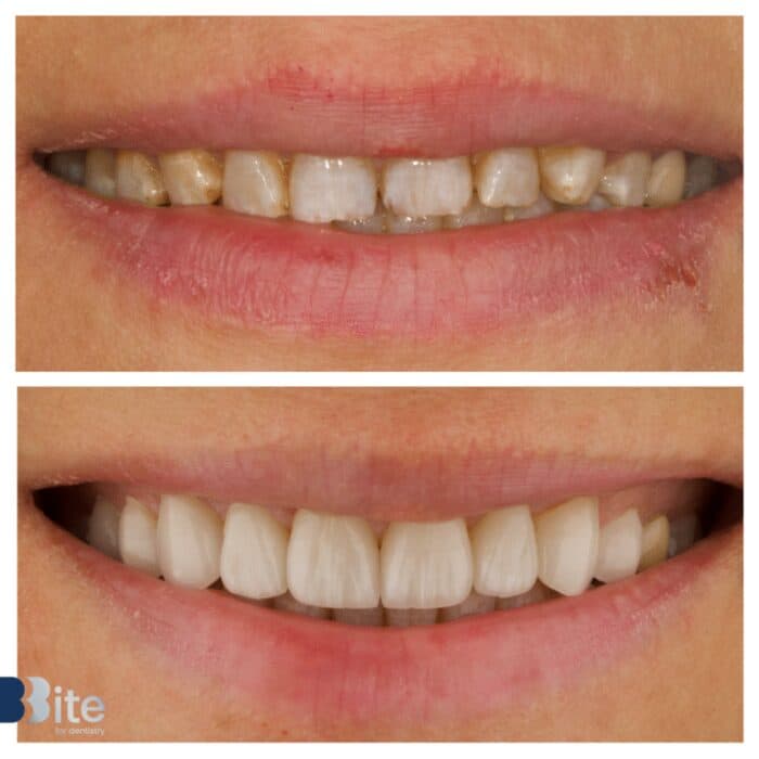 Veneers — before and after, a real Bite patient
