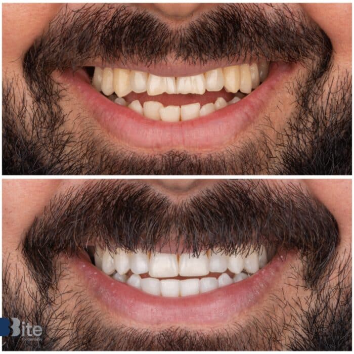 Whitening — before and after, a real Bite patient