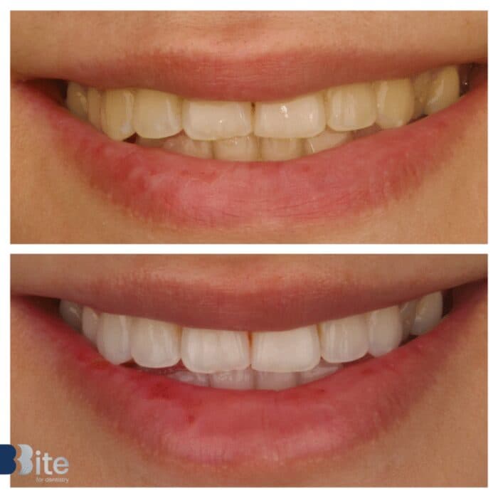 Whitening — before and after, a real Bite patient