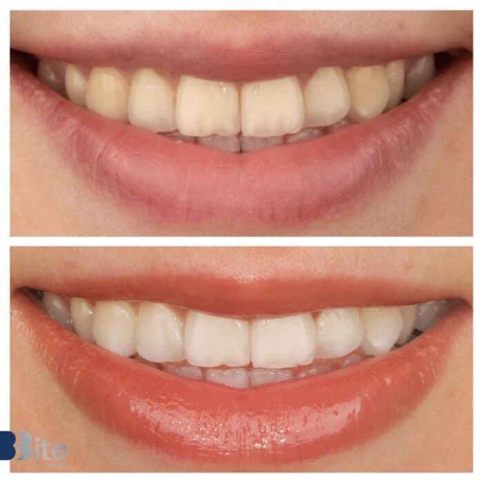 Whitening — before and after, a real Bite patient